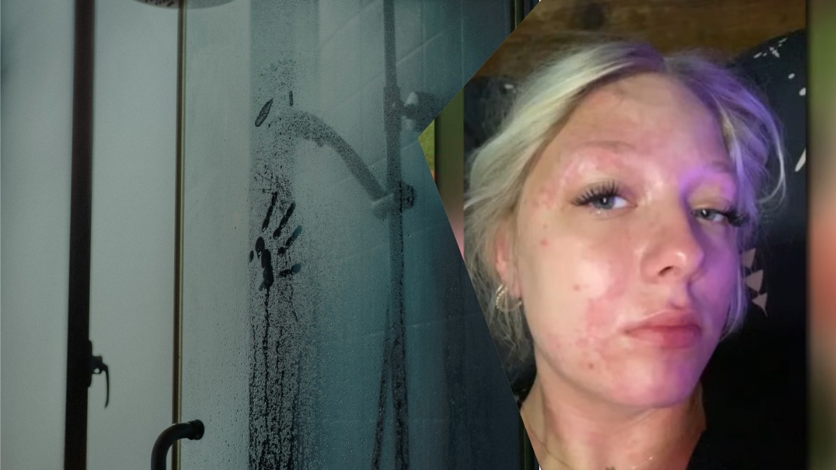 Texas teen gets chemical burns in shower